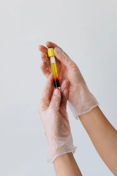 Zdjęcie osocza po odwirowaniu (centrifugacji) do terapii PRP